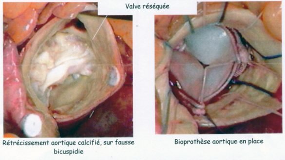 Remplacement valvulaire Aortique par bioprothese