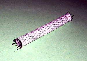 Un stent couvert de 8 mm utilisé pour les lésions iliaques.