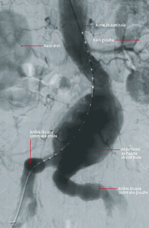 endoprothese aorto bi-ilaque