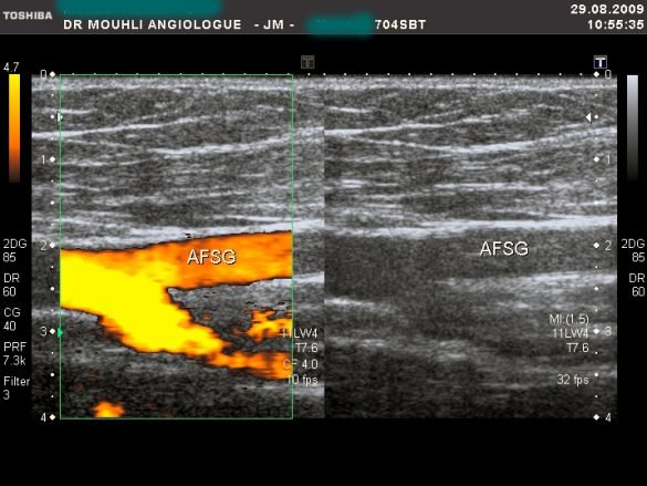 bifurcation-femorale