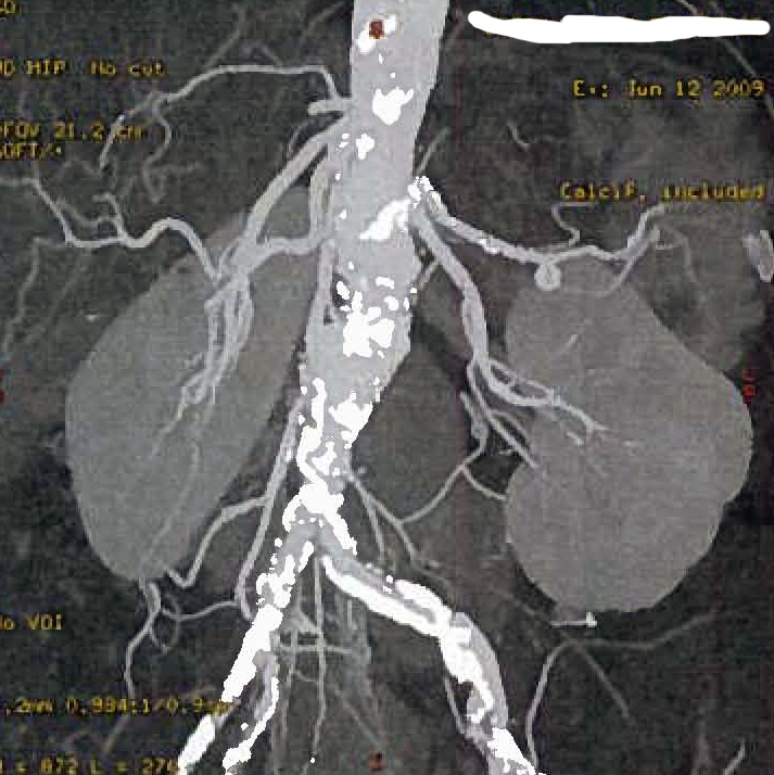 angioscanner aortobi-Iliaque et des artère rénale