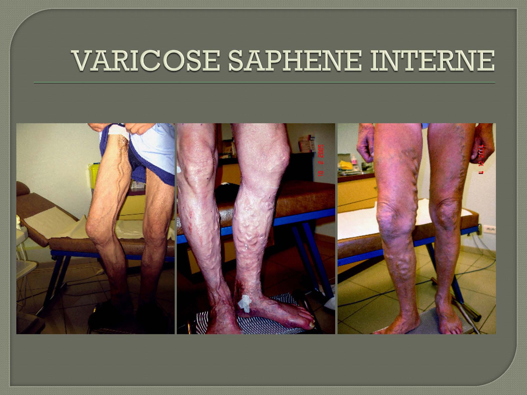 Varicose Vein treatment EVLT and phlebectomy Ablation