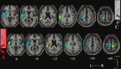 © Image reprise de : Peyron et al., Neurology (2004), 63 : 1838-1846. Etude des réponses cérébrales à la douleur