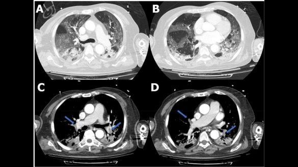Published today in @radiology_rsna : Pulmonary, Cerebral, and Renal Thromboembolic Disease Associated with COVID-19 Infection. https://bit.ly/3bA4eYG #COVID19