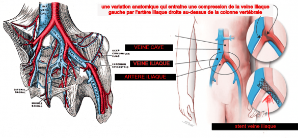 Qu’est-ce que le syndrome de Cockett ? Le syndrome de Cockett , également connu sous le nom de syndrome de May-Thurner ou syndrome de compression de la veine iliaque ou syndrome de compression iliocave, est une maladie vasculaire qui consiste en une compression de la veine iliaque gauche par l'artère iliaque droite sur le rachis lombaire au niveau de sa bifurcation, en L'abdomen. Qu’est-ce que le syndrome de Cockett ? La veine iliaque gauche est une voie importante pour que le sang s'écoule de la jambe gauche, tandis que l'artère iliaque droite est une voie importante pour que le sang passe vers la jambe droite. Cette compression entraîne un ralentissement de la circulation veineuse de la jambe gauche, ce qui peut générer des signes, symptômes et complications liés à cette difficulté à ramener le sang vers le cœur.