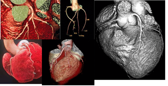 Le « coroscanner » (ou scanner cardiaque) est un examen d'imagerie médicale utilisant des rayons X pour visualiser le cœur et ses artères coronaires. Il permet de détecter des obstructions partielles ou complètes, des plaques d'athérome et d'évaluer le risque cardiovasculaire. L'examen implique une injection intraveineuse de produit de contraste iodé et une synchronisation avec l'électrocardiogramme pour obtenir des images nettes.