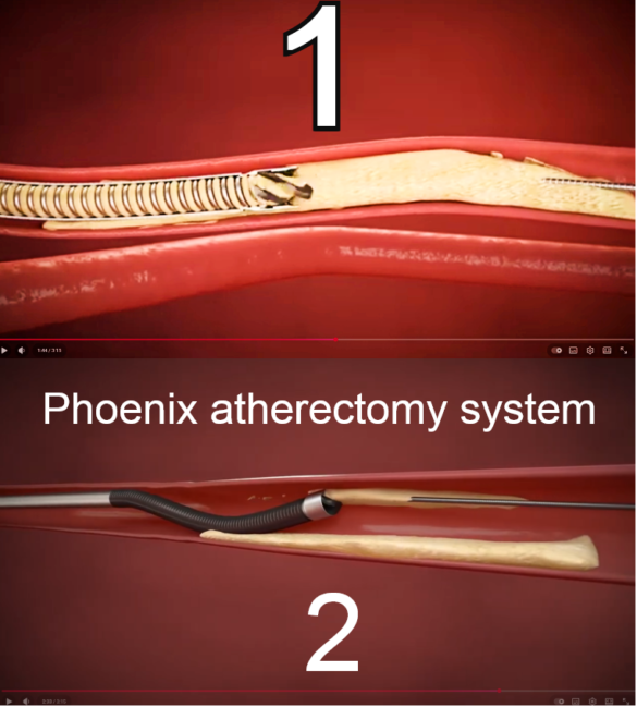 Le système d’athérectomie Phoenix combine les avantages des systèmes existants pour offrir une option unique d’athérectomie afin d’aider les médecins à adapter l’approche thérapeutique à chaque patient. Il coupe, capture et élimine les tissus malades d’une seule insertion. Phoenix traite un large éventail de types de tissus, allant de la plaque molle aux artères calcifiées, et peut être utilisé pour les lésions au-dessus et en dessous du genou.¹ En savoir plus : https://www.usa.philips.com/healthcar... 1. Surveiller le flux des matériaux excisés dans le réservoir d’élimination pendant le fonctionnement du cathéter. Si l’écoulement de matière excisée cesse pendant la procédure, cela indique que le système d’entraînement du cathéter (coupe, arbre de couple ou entraînement du moteur de la poignée) pourrait ne pas fonctionner correctement.